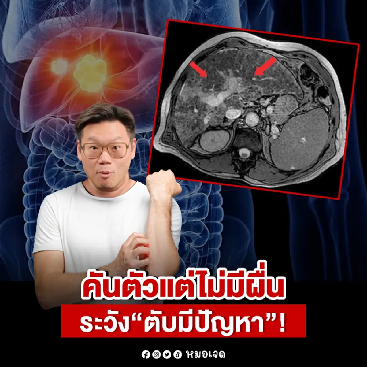 หมอเตือนด่วน คันทั้งตัวแต่ไม่มีผื่นขึ้น ใครมีอาการนี้ ระวัง 