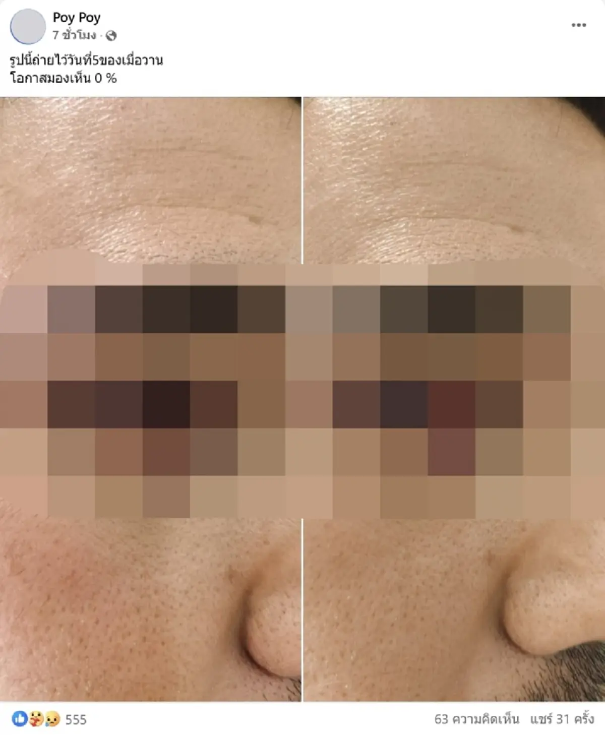 สาวทุกข์ใจ แฟนผ่าตัดริดสีดวงจมูก รพ.ดัง พลาดทำเส้นประสาทตาขาด