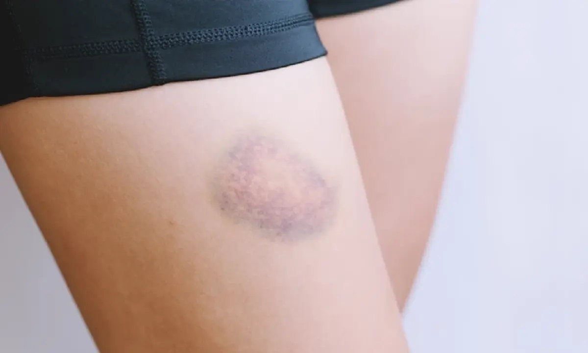 4 วิธีรักษารอยช้ำให้หายไว เผยผิวกลับมาเนียนใส ไม่ทิ้งรอยให้กวนใจ