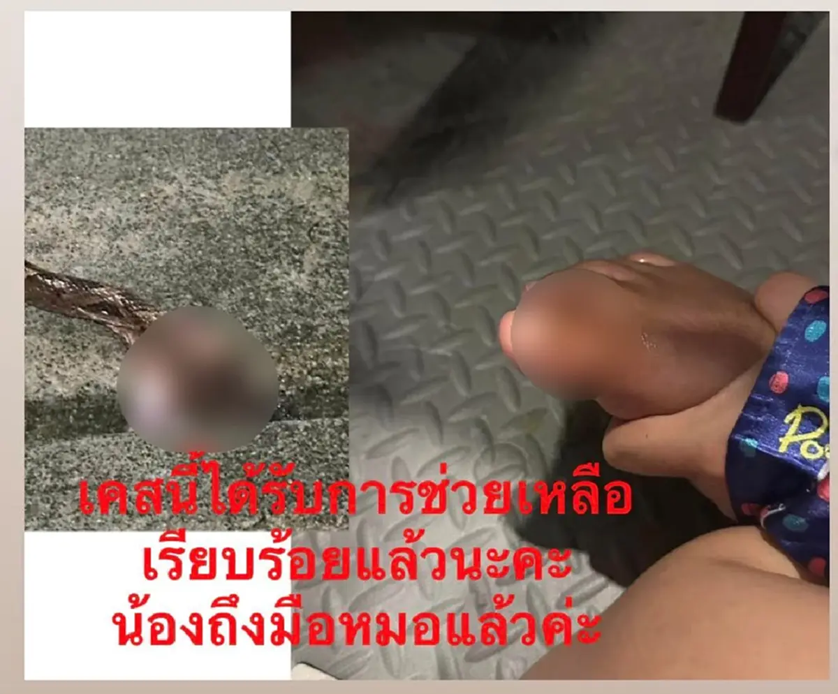 อาการล่าสุด สาวถูกงูกะปะกัดข้ามคืน เหตุน้ำท่วมหาดใหญ่
