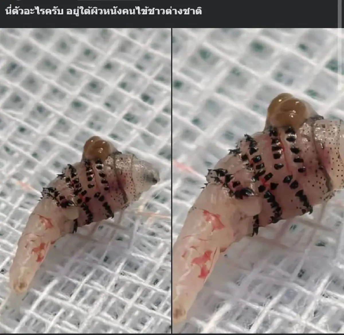 สุดสยอง รู้แล้ว \"ตัวอะไร\" อยู่ใต้ผิวหนัง คนไข้ชาวต่างชาติ