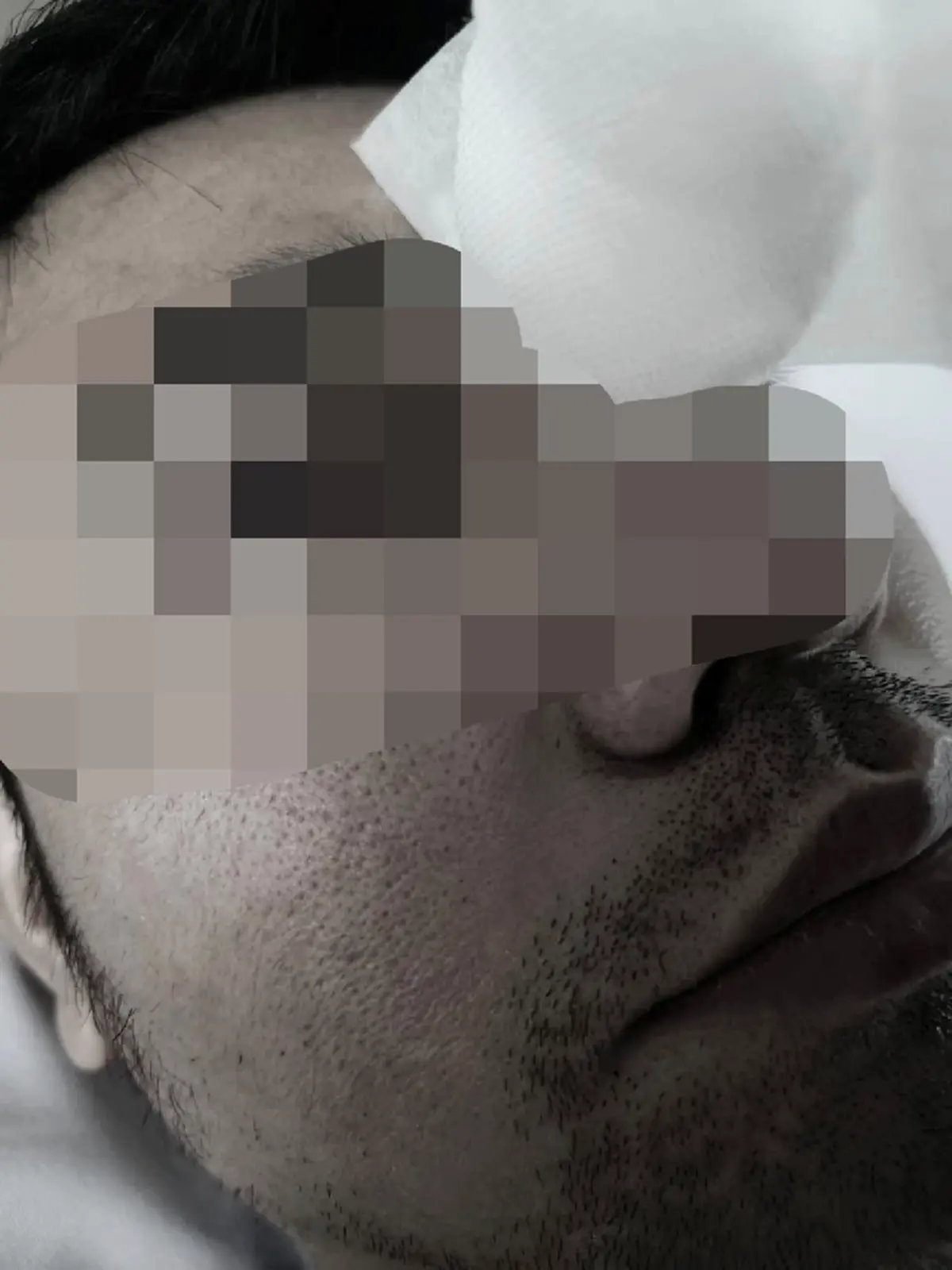 สาวทุกข์ใจ แฟนผ่าตัดริดสีดวงจมูก รพ.ดัง พลาดทำเส้นประสาทตาขาด