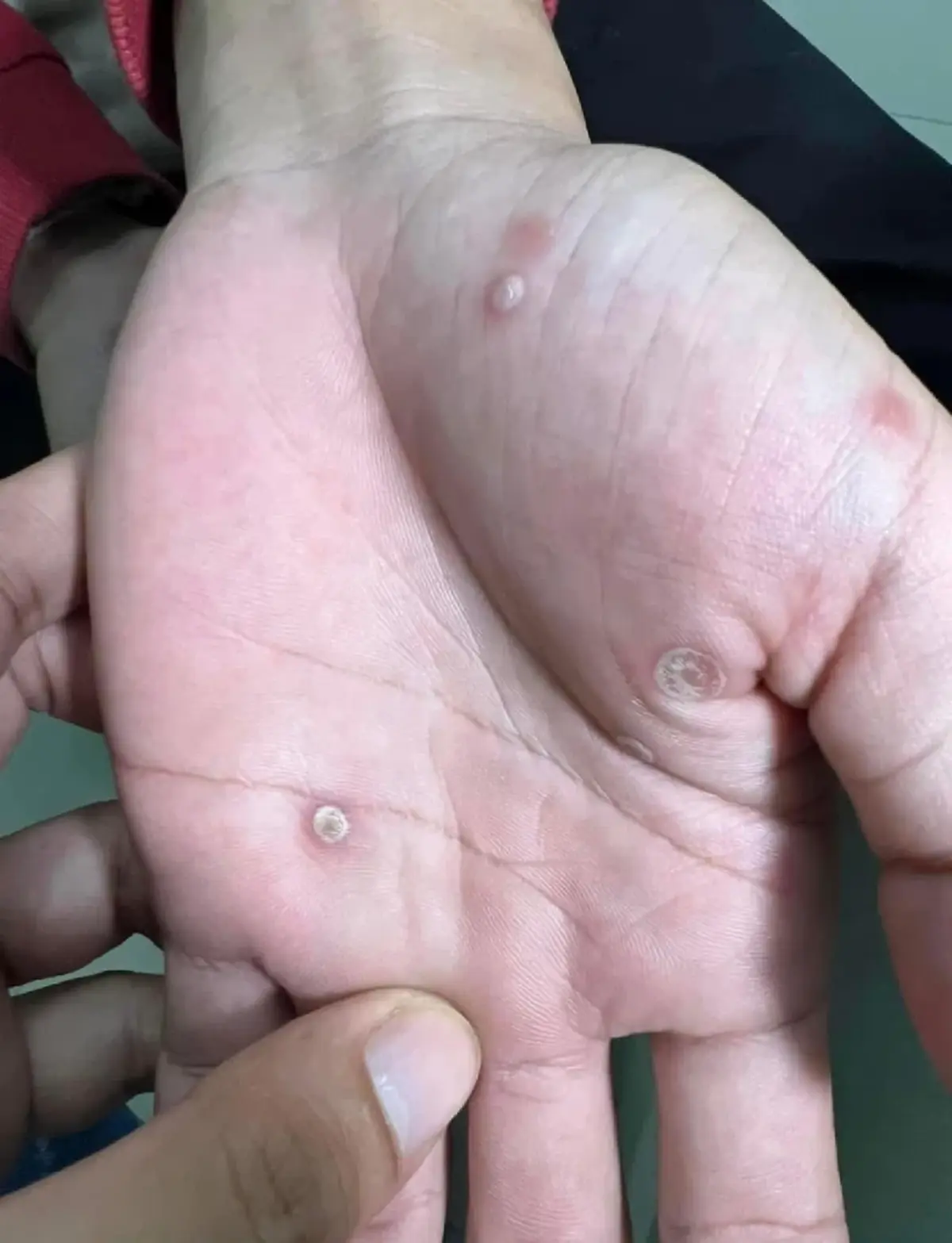 หมอเตือน ซิฟิลิสระบาดหนัก แล้ว ใครมีอาการดังนี้ ไปหาหมอด่วน