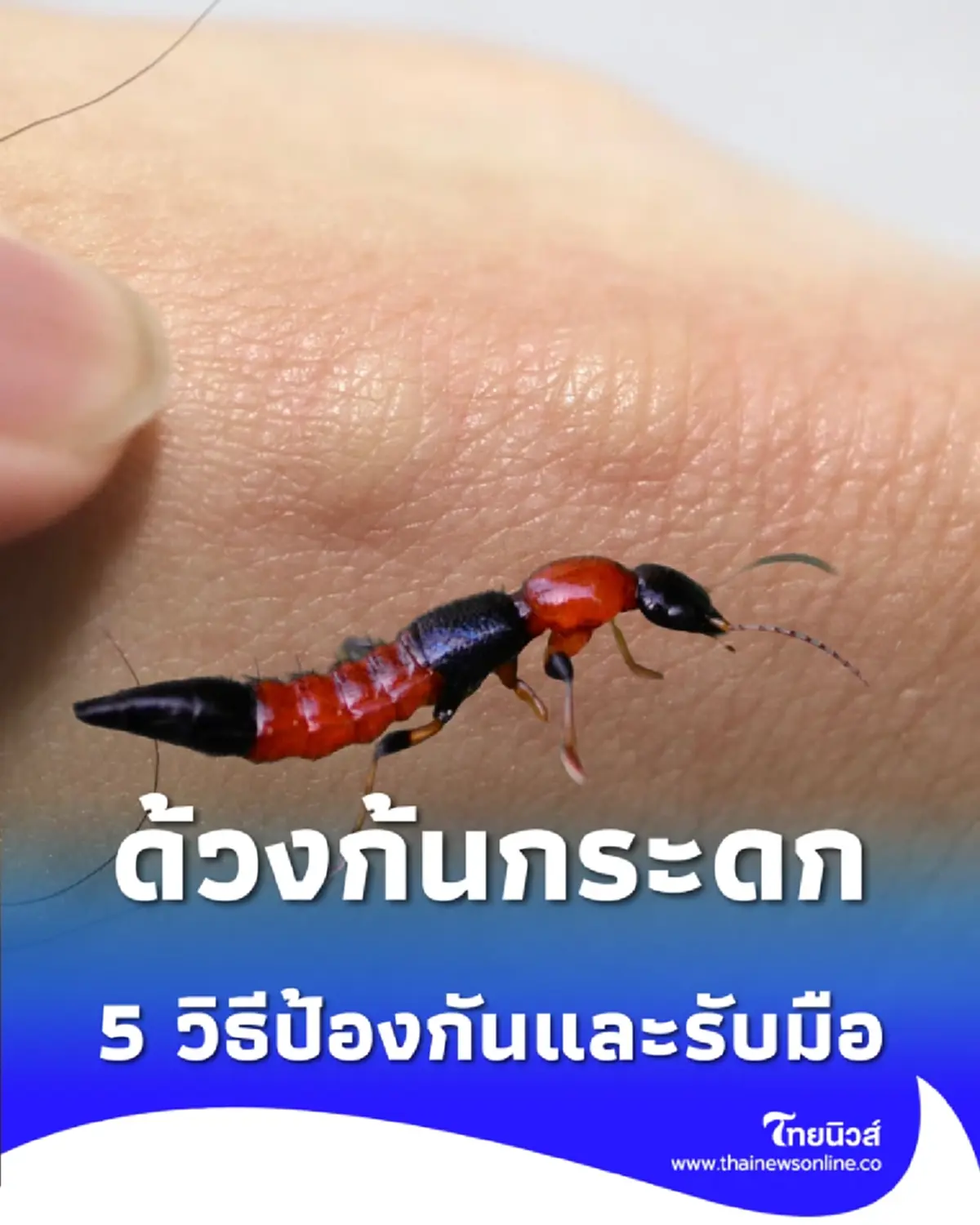 ด้วงก้นกระดก  แมลงร้ายที่ไม่กัด แต่ปล่อยพิษทำผิวหนังอักเสบแดง-แสบพอง