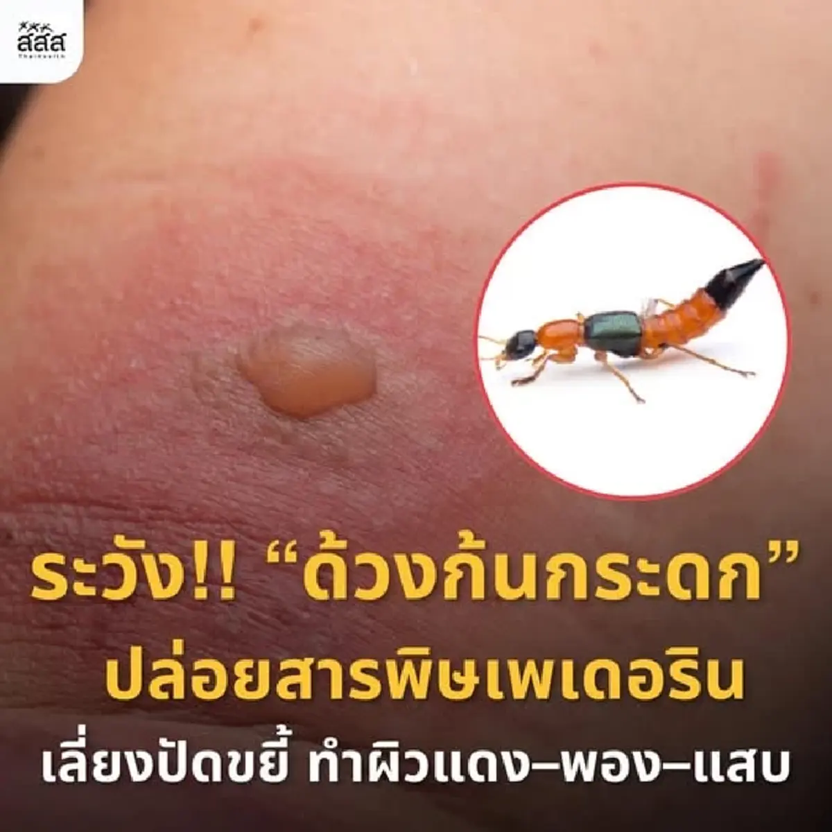 ด้วงก้นกระดก  แมลงร้ายที่ไม่กัด แต่ปล่อยพิษทำผิวหนังอักเสบแดง-แสบพอง