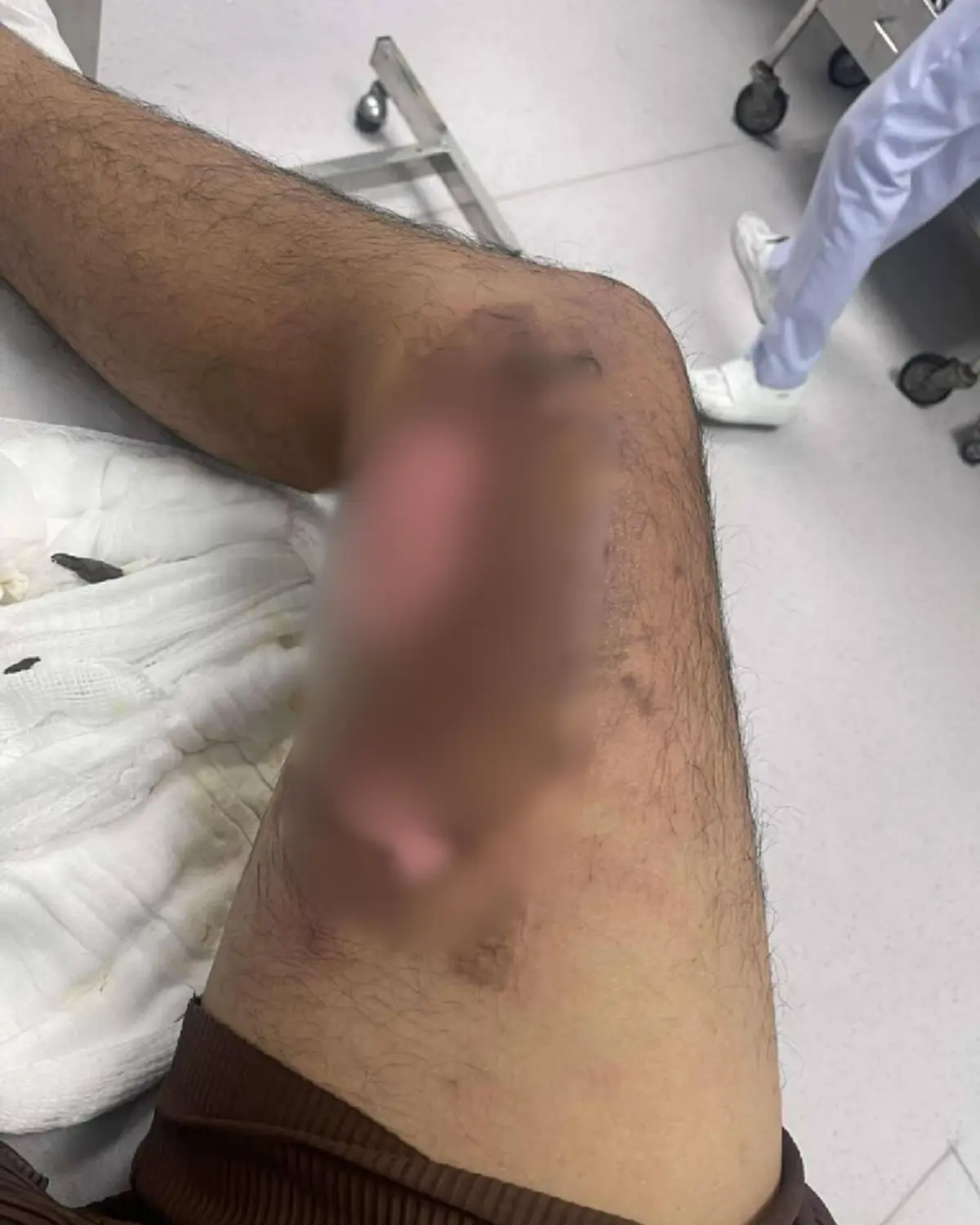 ส้มตำร้านดัง หม้อไฟคว่ำใส่ลูกค้าเจ็บหนัก คำตอบร้านยิ่งเจ็บใจ