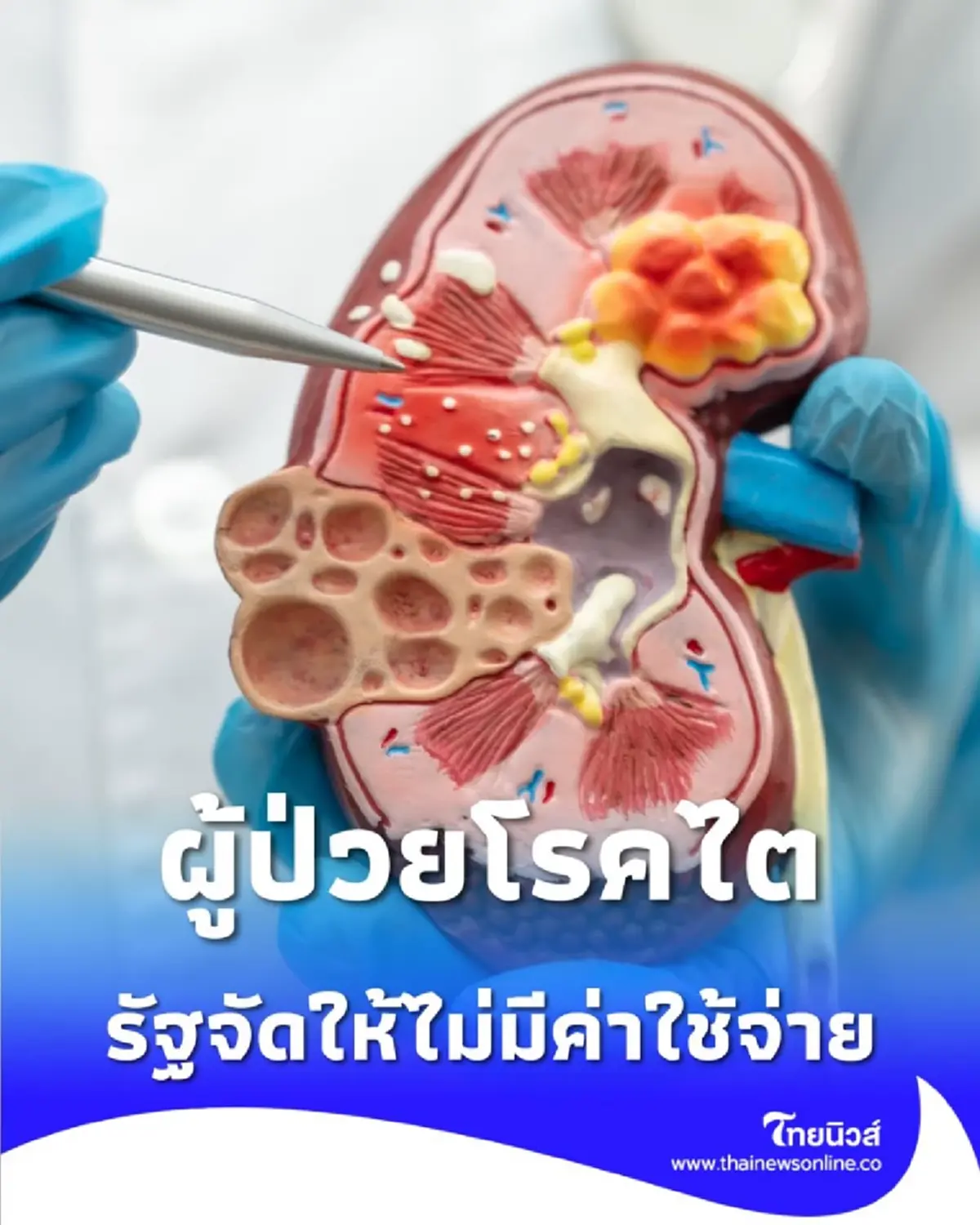 ข่าวดีคนไข้ไต พื้นที่น้ำท่วมไม่ต้องกังวล รัฐจัดให้ไม่มีค่าใช้จ่าย