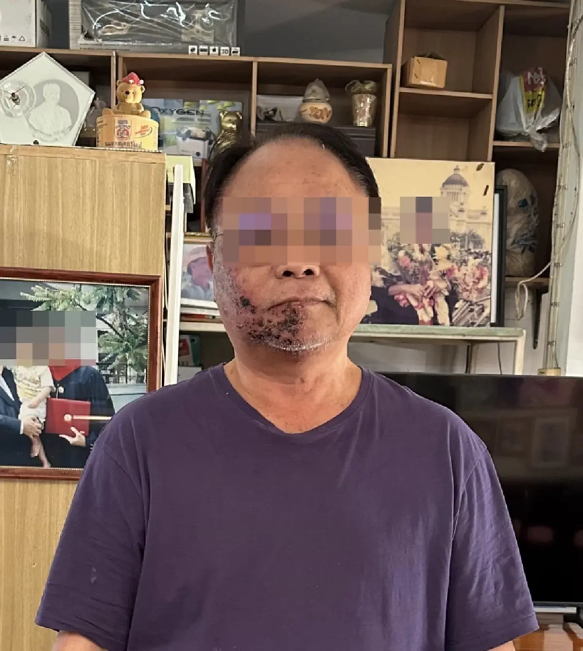 อุทาหรณ์ชั้นดี หมดเงินเฉียดล้าน เหตุเพราะเป็น โรคงูสวัด