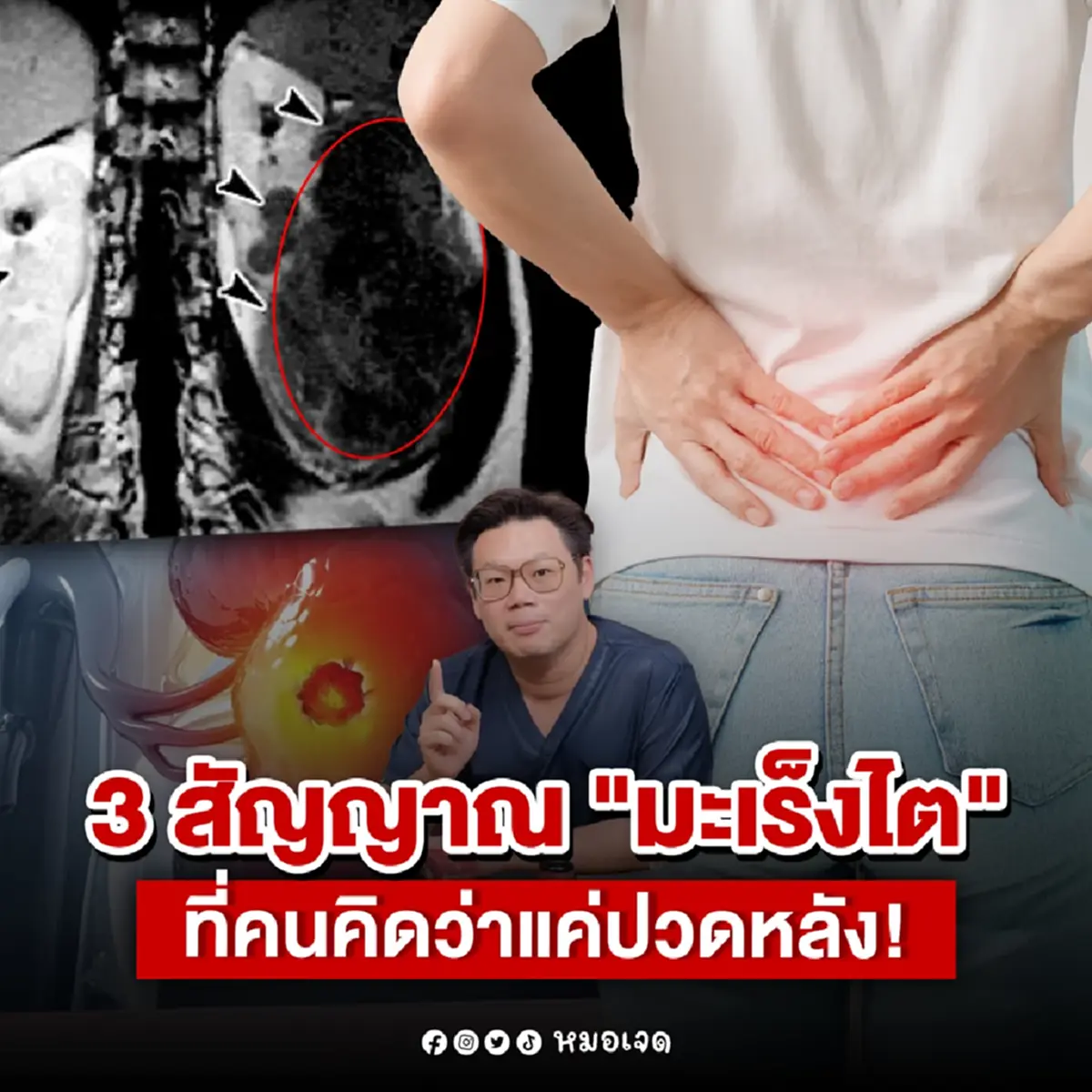 4 สัญญาณเตือน ใครเป็นอยู่ ระวังให้ดี คุณอาจกำลังเป็น มะเร็งไต