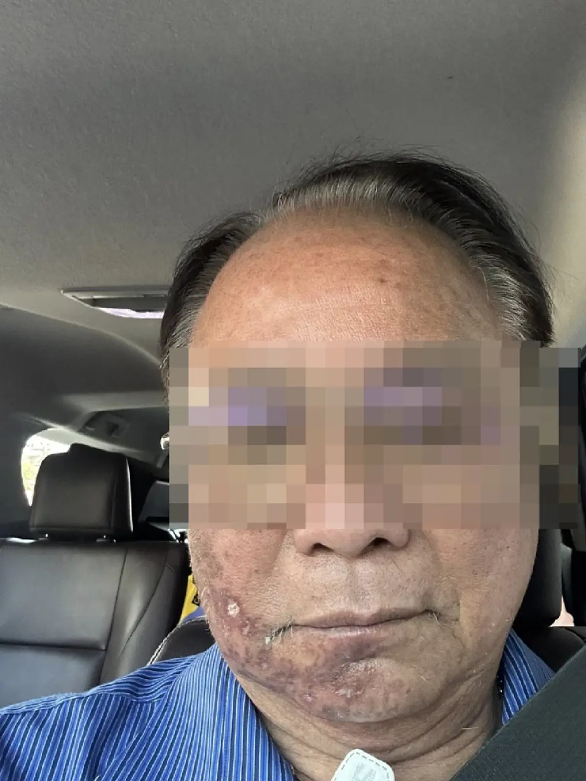 อุทาหรณ์ชั้นดี หมดเงินเฉียดล้าน เหตุเพราะเป็น โรคงูสวัด