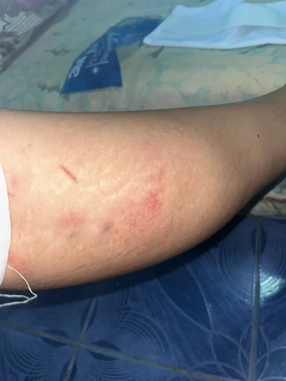 ชีวิตจริงพยาบาลสาว รถล้มเจ็บก็ต้องมาทำงาน เหตุผลตัดสินใจลาออก