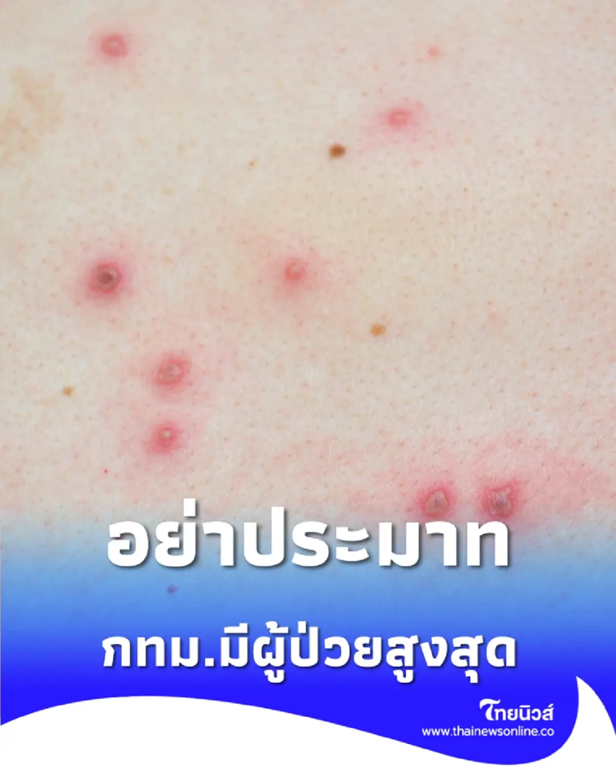 กทม.พบผู้ป่วยฝีดาษวานรสูงสุด รัฐบาลย้ำหลีกเลี่ยงพฤติกรรมเสี่ยง