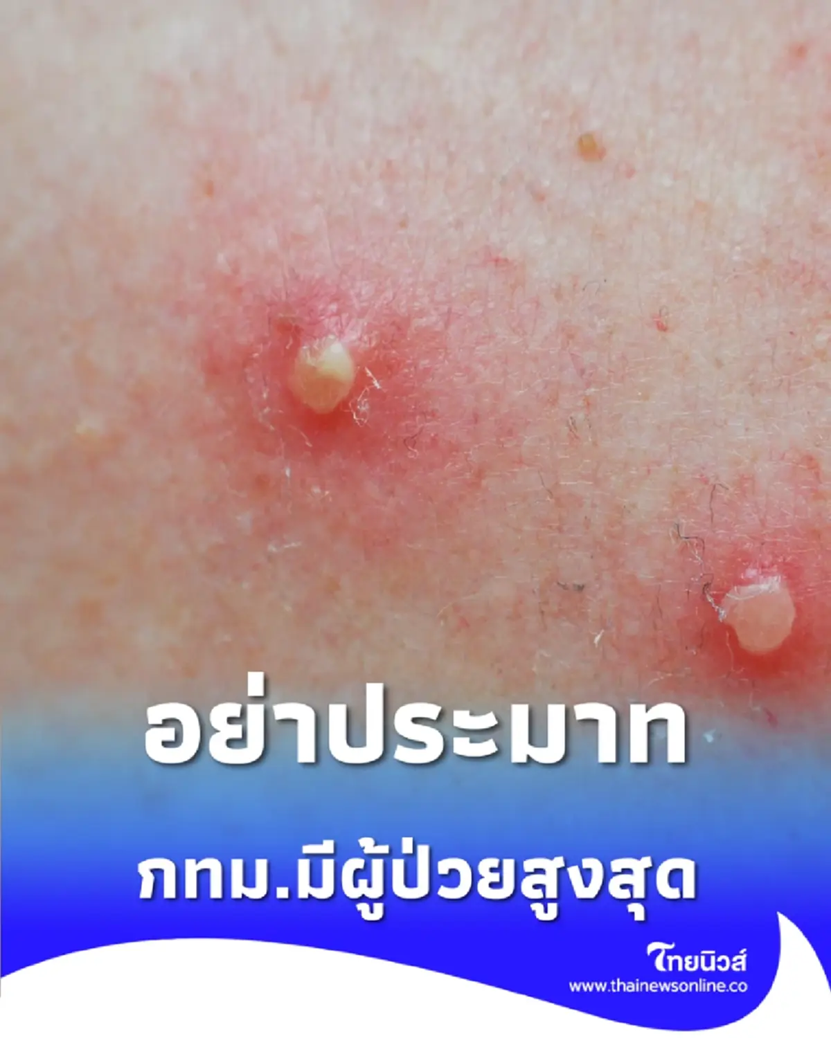 กทม.พบผู้ป่วยฝีดาษวานรสูงสุด รัฐบาลย้ำหลีกเลี่ยงพฤติกรรมเสี่ยง