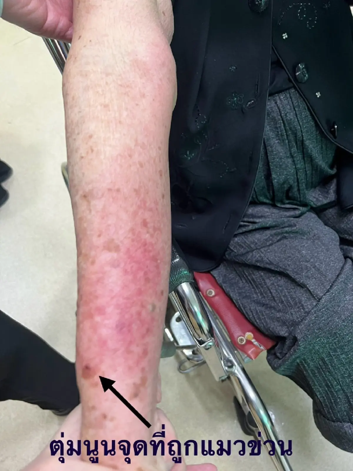 รู้จัก โรคแมวข่วน หมอโพสต์เตือน ใครเลี้ยงแมว ต้องรู้ 