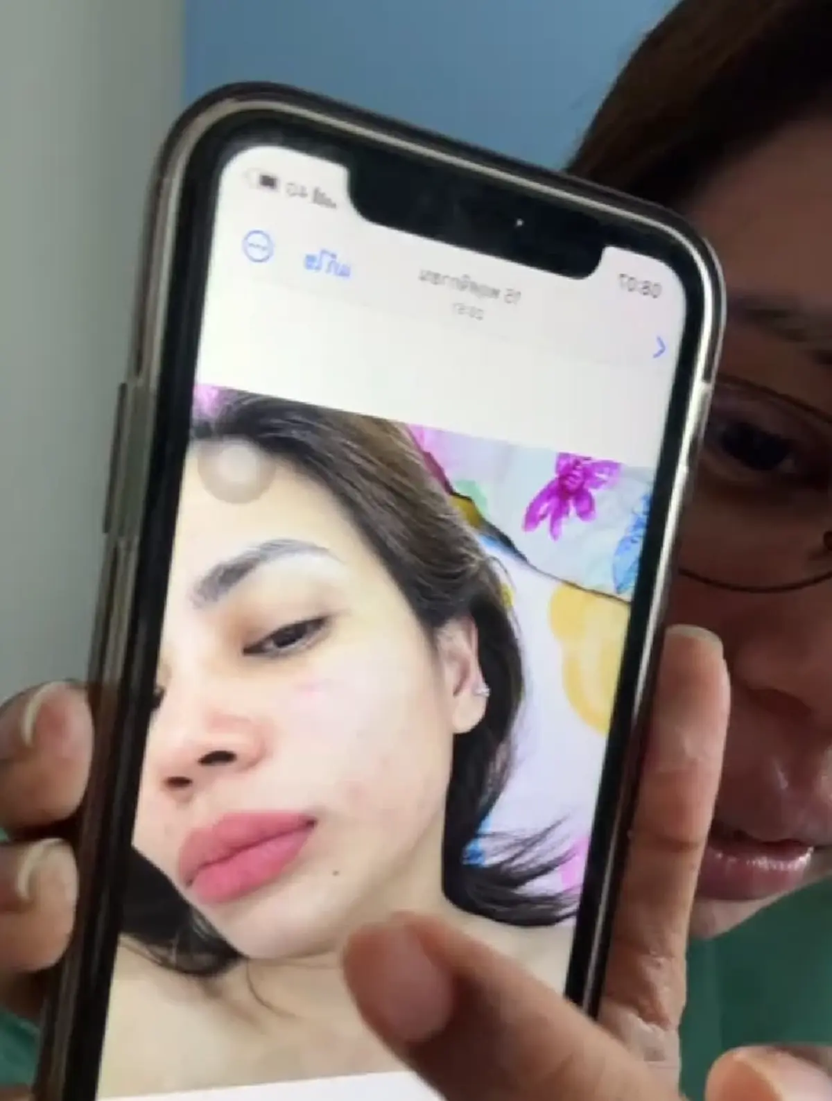 สาวเล่าอุทาหรณ์ แค่ผื่นเล็ก ๆ สุดท้ายเกือบเอาชีวิตไม่รอด