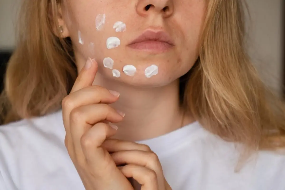 รักษารอยสิว