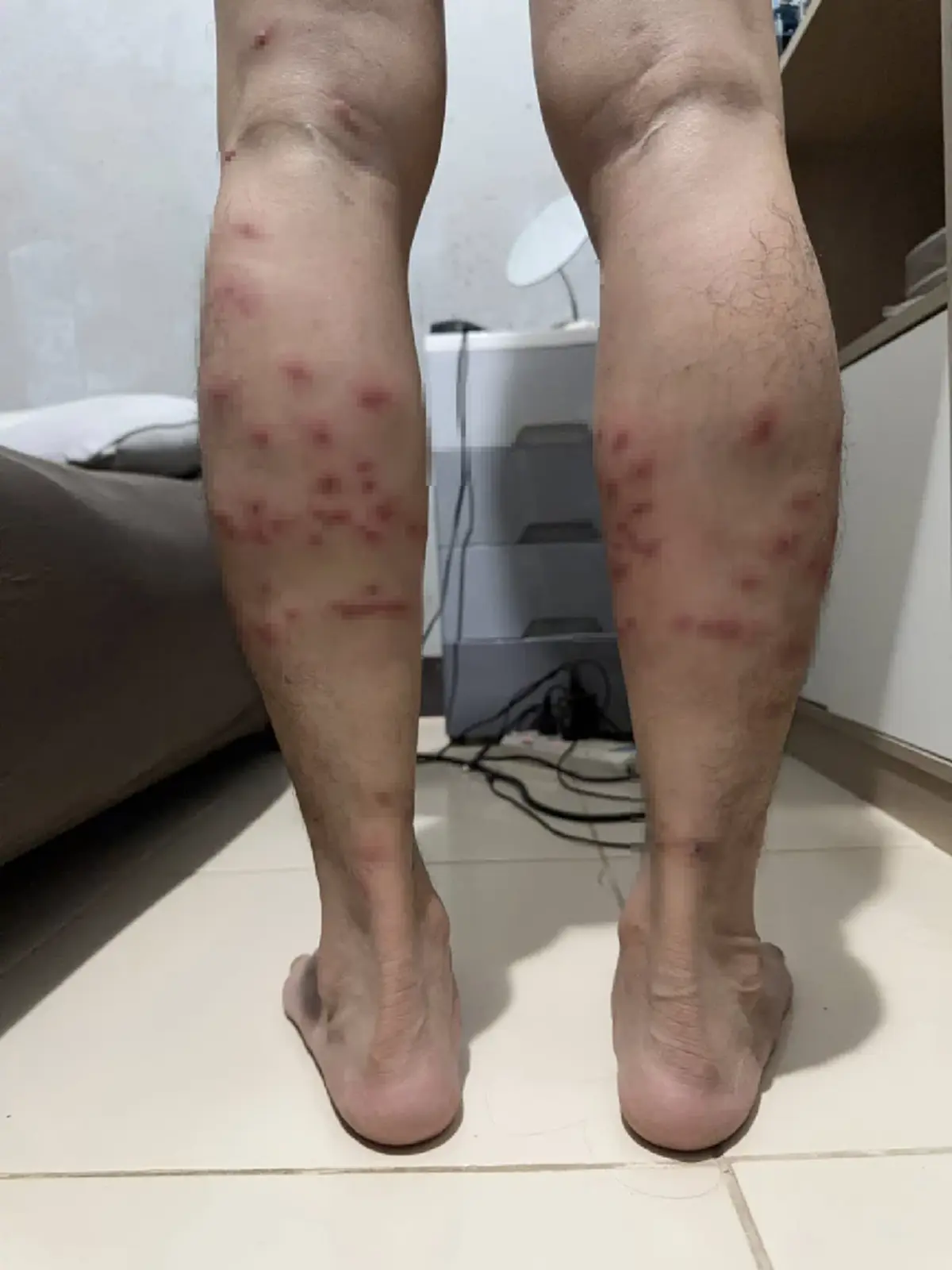 เตือน "ตัวคุ่น" แมลงจิ๋วพิษร้าย กัดแล้วคัน แผลลุกลามหนัก