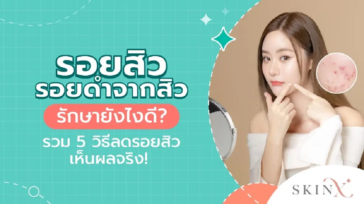 เลอเซอร์รอยสิวที่หลัง