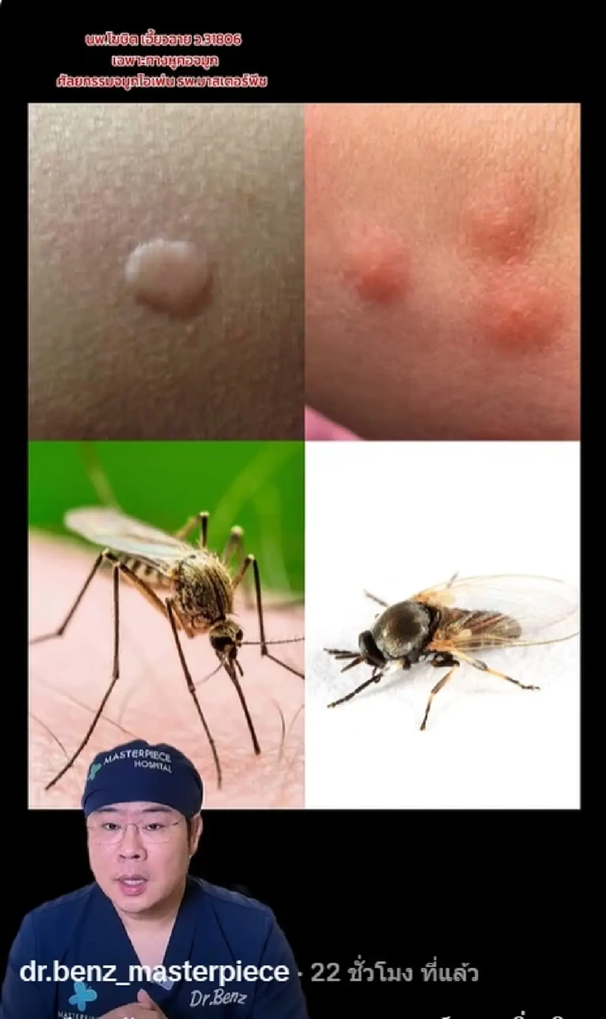 หมอดัง เผยชัด "ยุง vs คุ่น" ต่างกันตรงไหน เสี่ยงติดเชื้อได้ยังไง