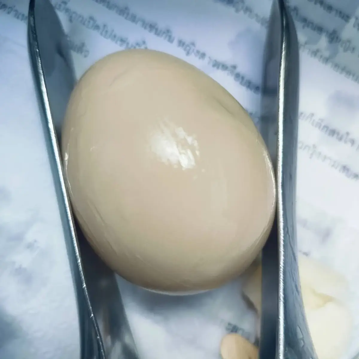 ผู้ป่วยมีสิ่งแปลกปลอมติดในช่องคลอด บางชิ้นหมอก็เพิ่งเคยเจอ