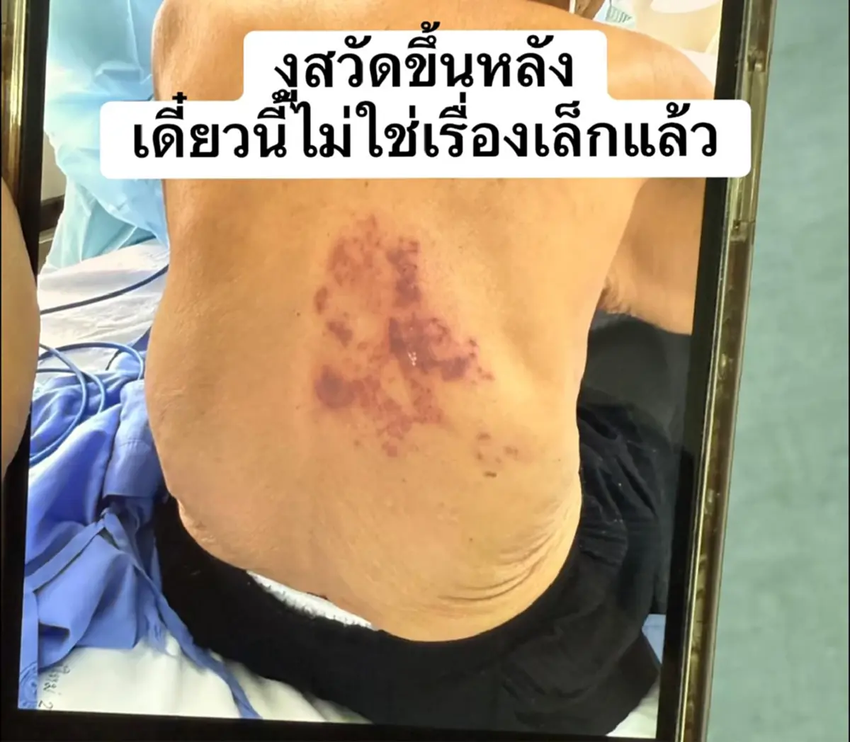 หลายคนไม่เคยรู้ สิ่งที่ตามมาหลัง "งูสวัด" หาย ยิ่งรู้ ยิ่งน่าตกใจ