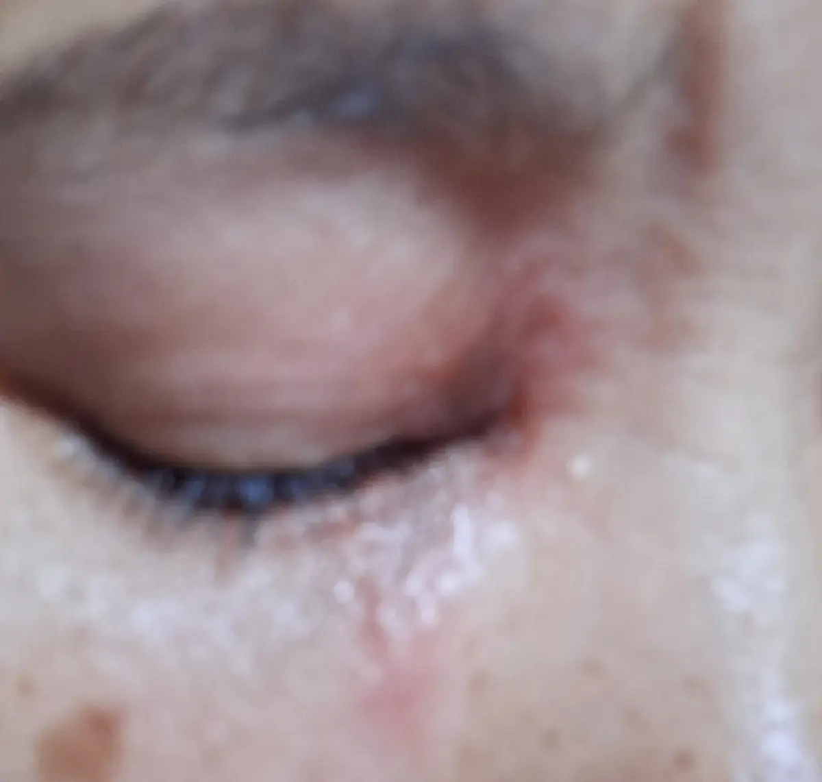 ระวังให้ดี เตือนแมลงตัวจิ๋วแต่พิษแรง โดนทีเดียวผิวไหม้สุดทรมาน