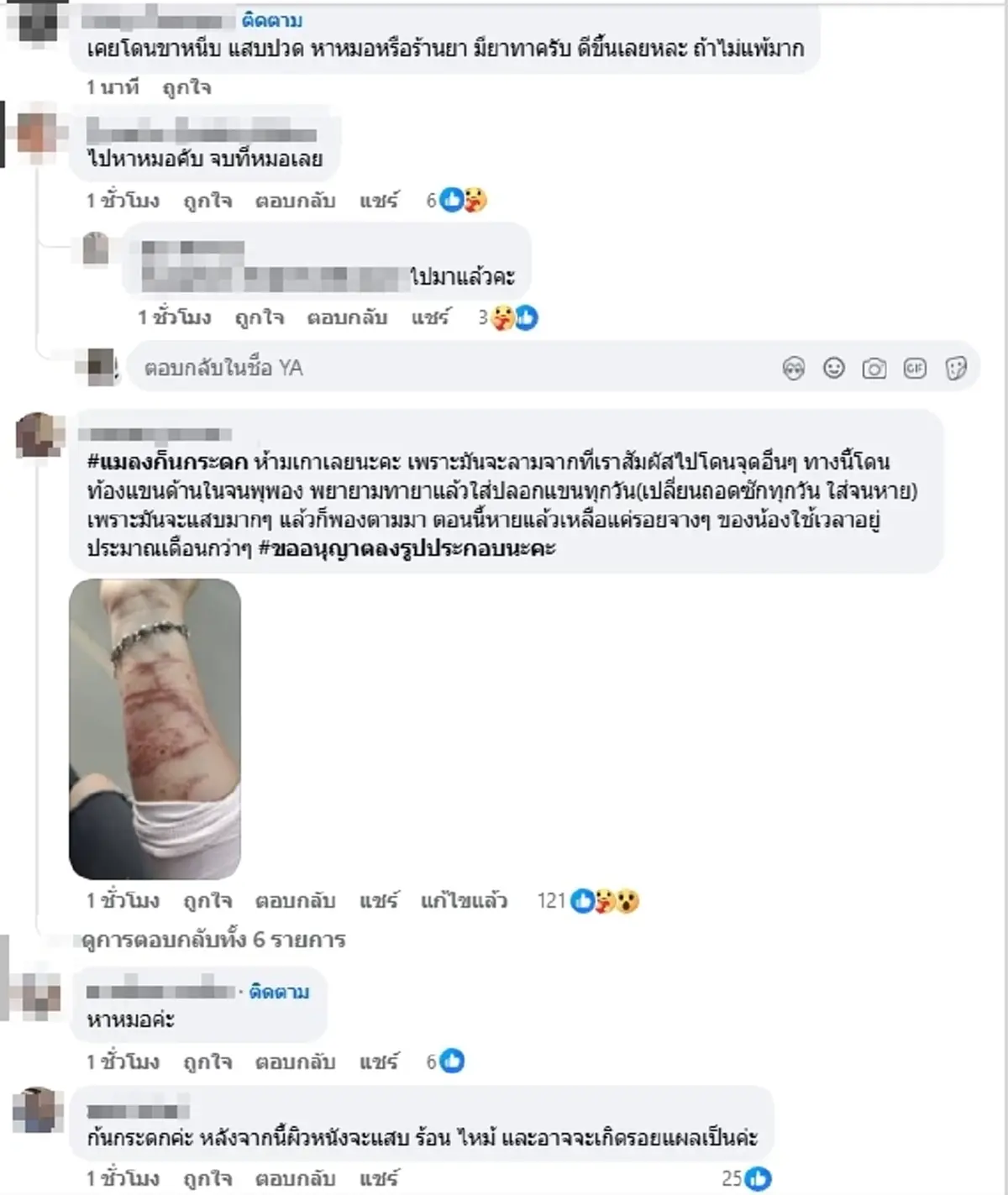 ระวังให้ดี เตือนแมลงตัวจิ๋วแต่พิษแรง โดนทีเดียวผิวไหม้สุดทรมาน