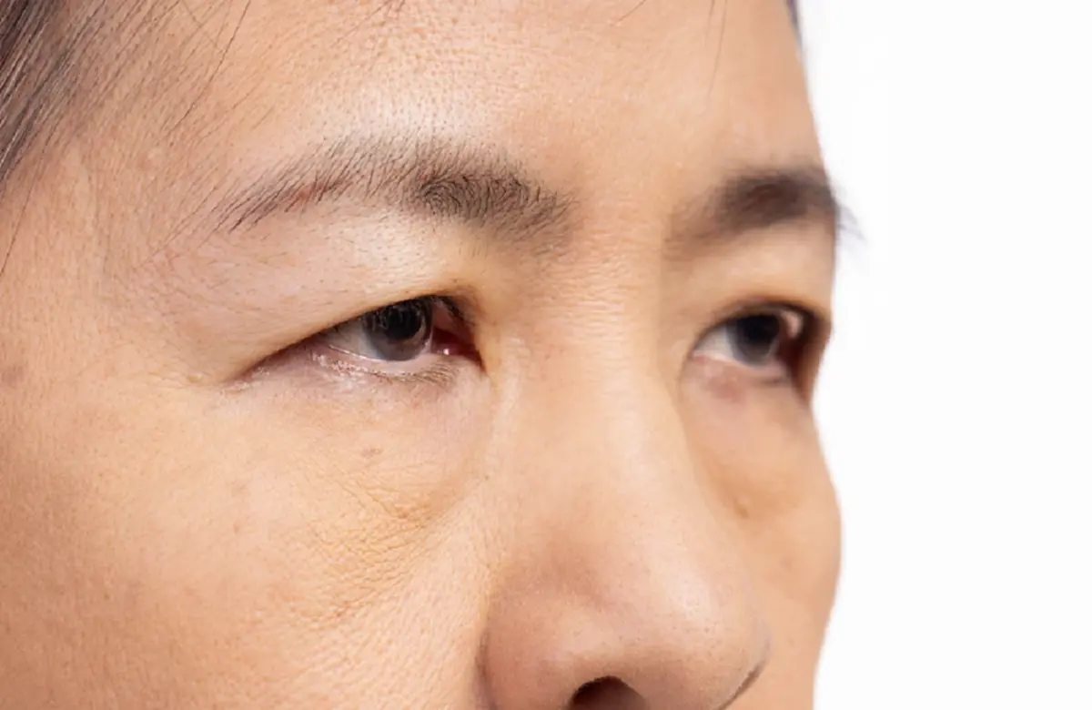 ดึงหางตา