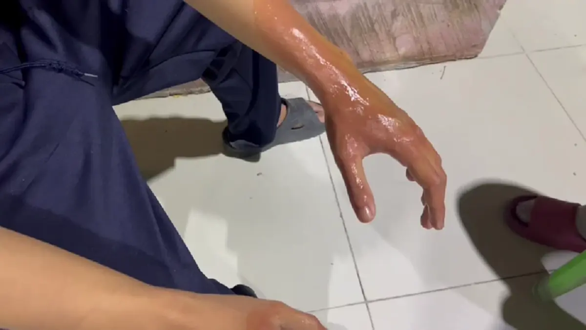 หวิดเสียโฉม! ไม้ตียุง 149 บาทระเบิดใส่หน้าหนุ่ม 18 เจ็บ