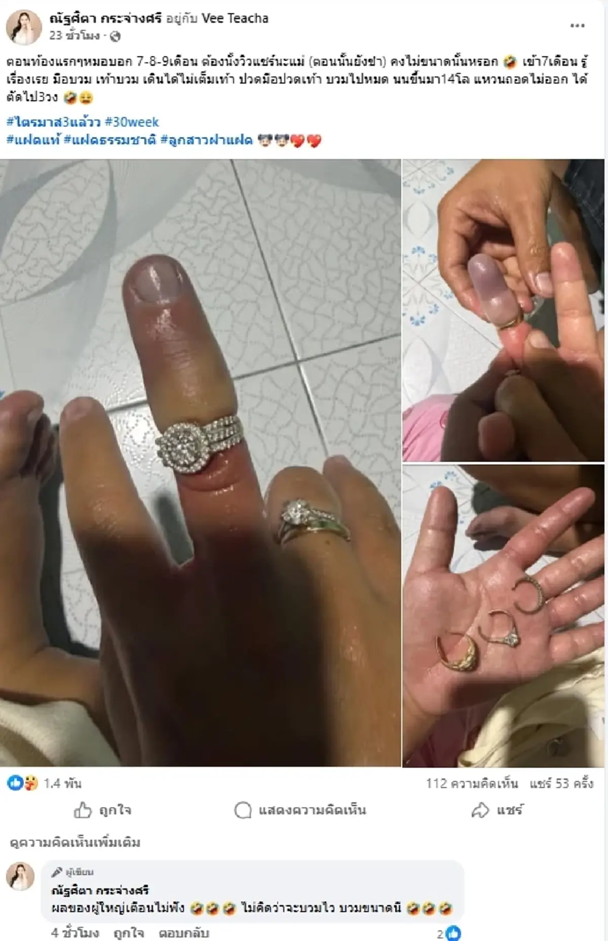 คุณแม่ท้องแฝด  เผยอาการสุดพีค ไตรมาสสุดท้าย แหวนแน่นจนถอดไม่ออก