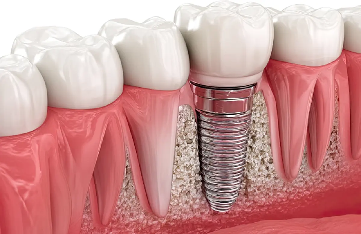 ทำรากฟันเทียม