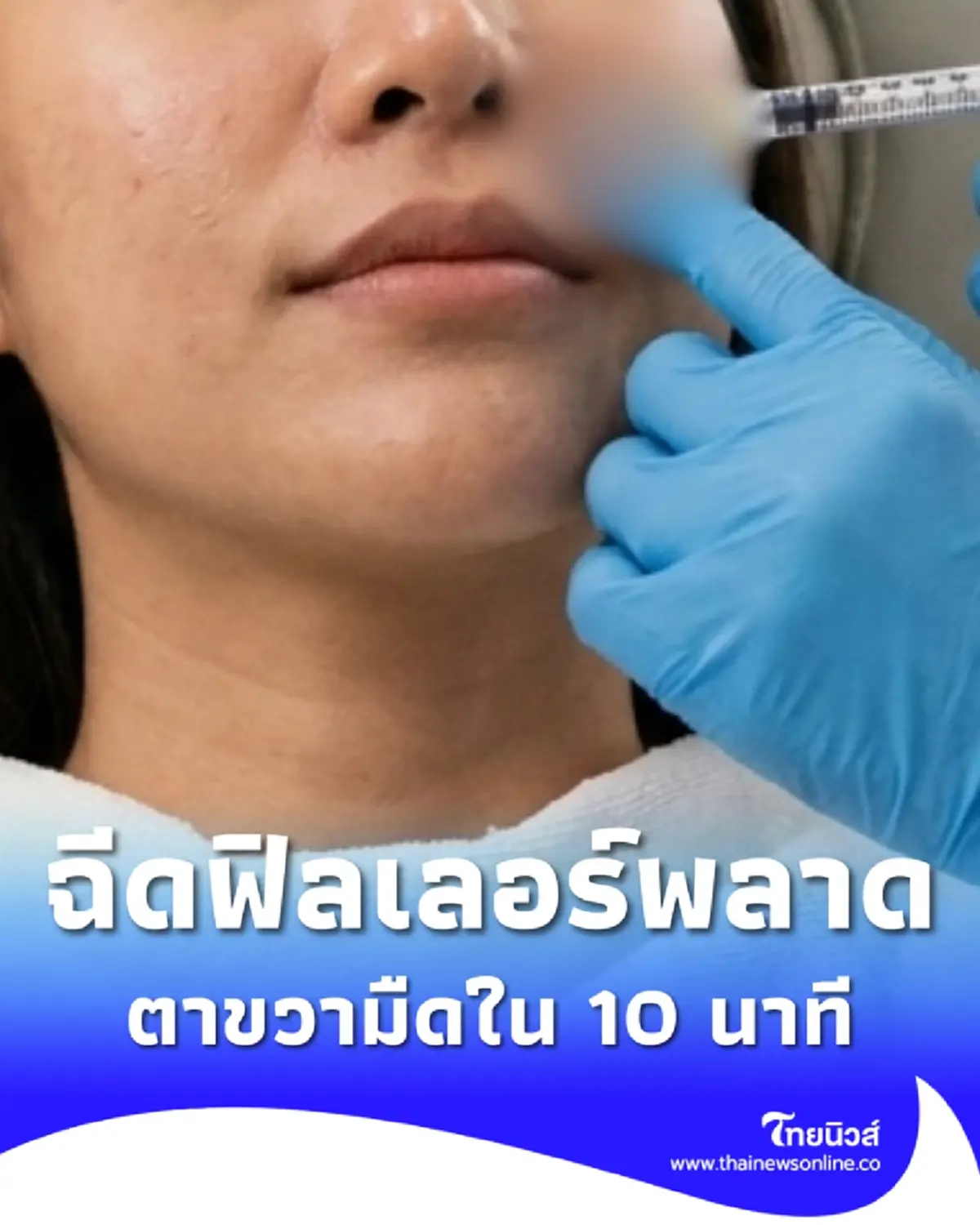 หมอเตือนภัย ฉีดฟิลเลอร์พลาด ตาขวามืดใน 10 นาที คงไม่ใช่เคสสุดท้าย