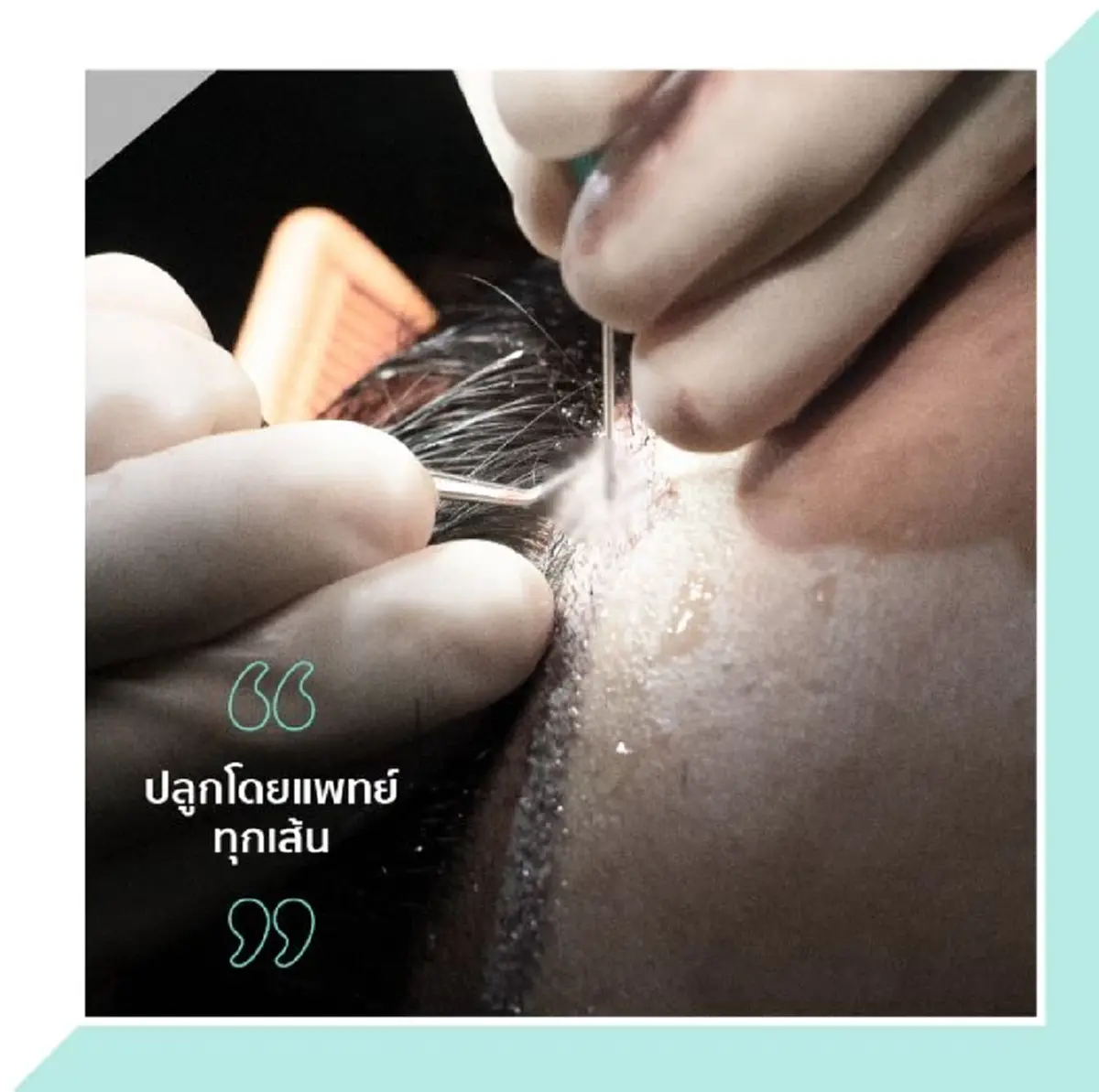 ใครเหมาะ เทคนิคปลูกผม FUE