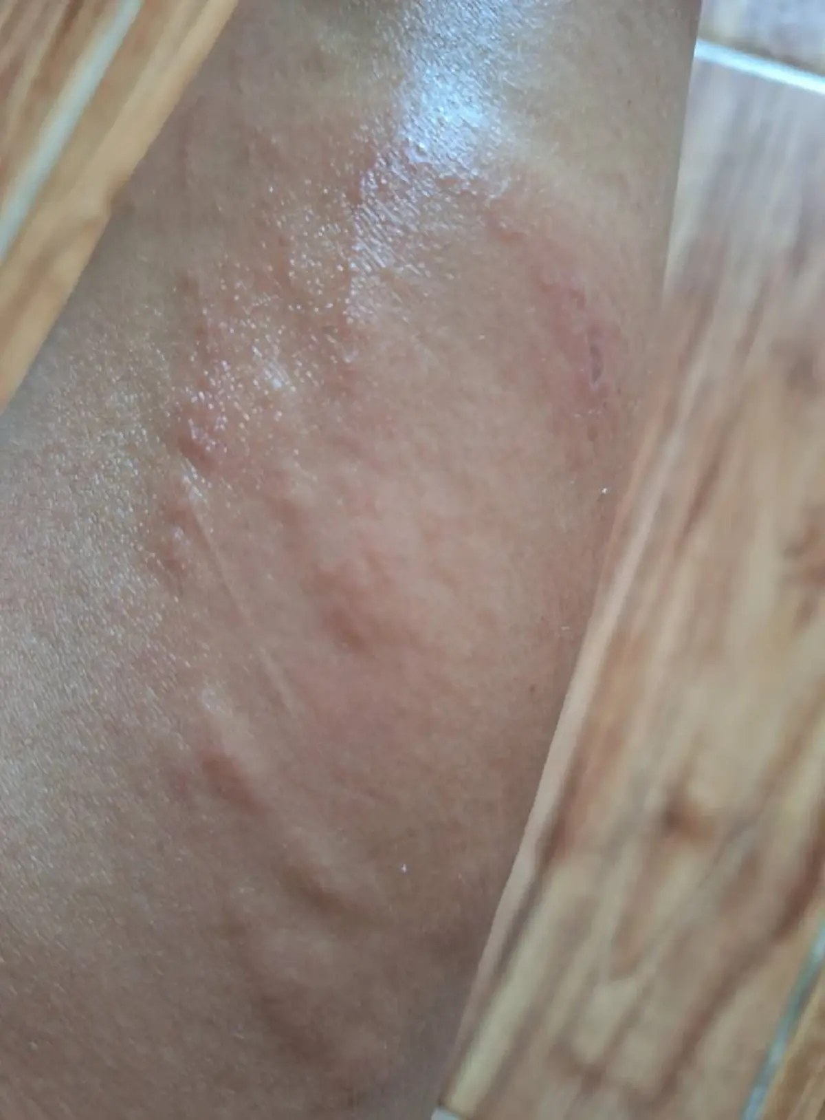 ระวังให้ดี เตือนแมลงตัวจิ๋วแต่พิษแรง โดนทีเดียวผิวไหม้สุดทรมาน