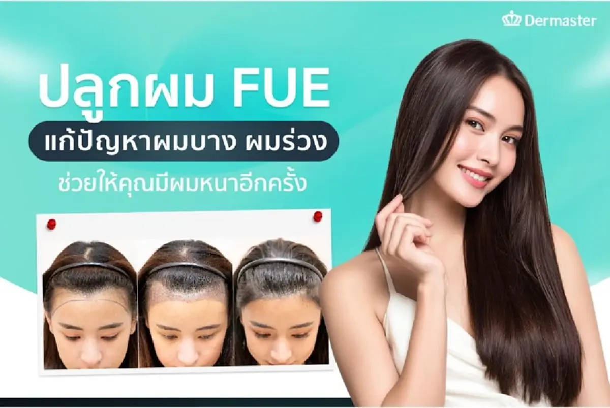ปลูกผม FUE