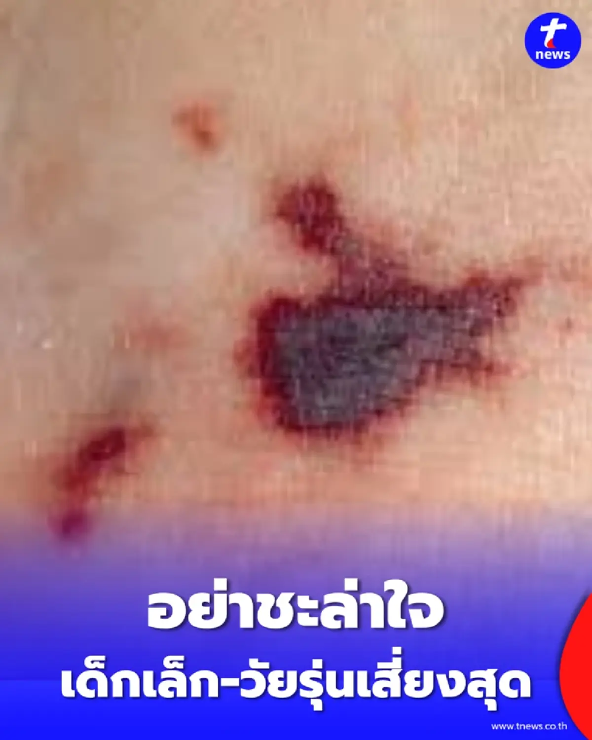 อย่าชะล่าใจ ไข้กาฬหลังแอ่นไทยพุ่งสูงสุดใน 10 ปี เด็กเล็ก-วัยรุ่นเสี่ยงสุด