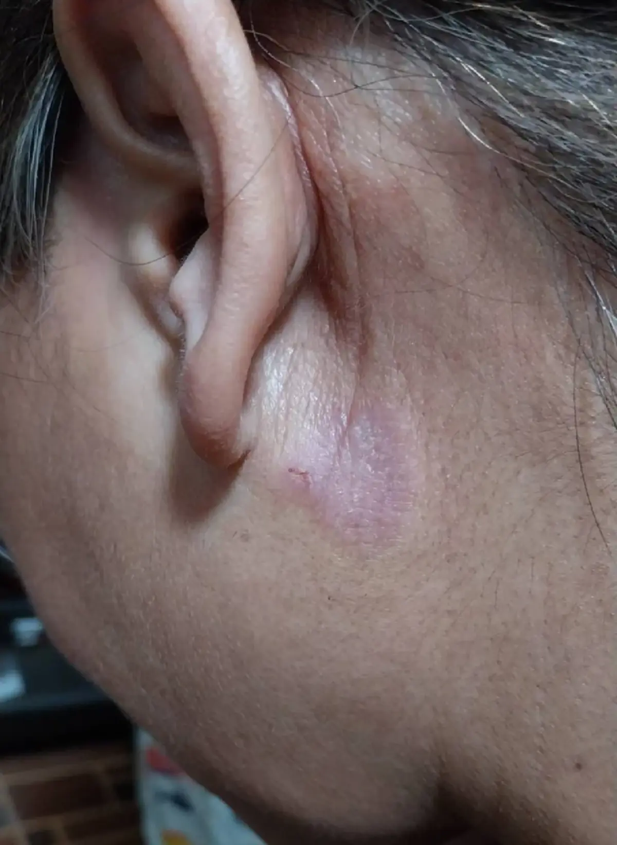 ขนลุก "ก้างปลาติดคอ" อยู่ๆ โผล่ทะลุหลังหู เพจดังเตือนอันตรายมาก