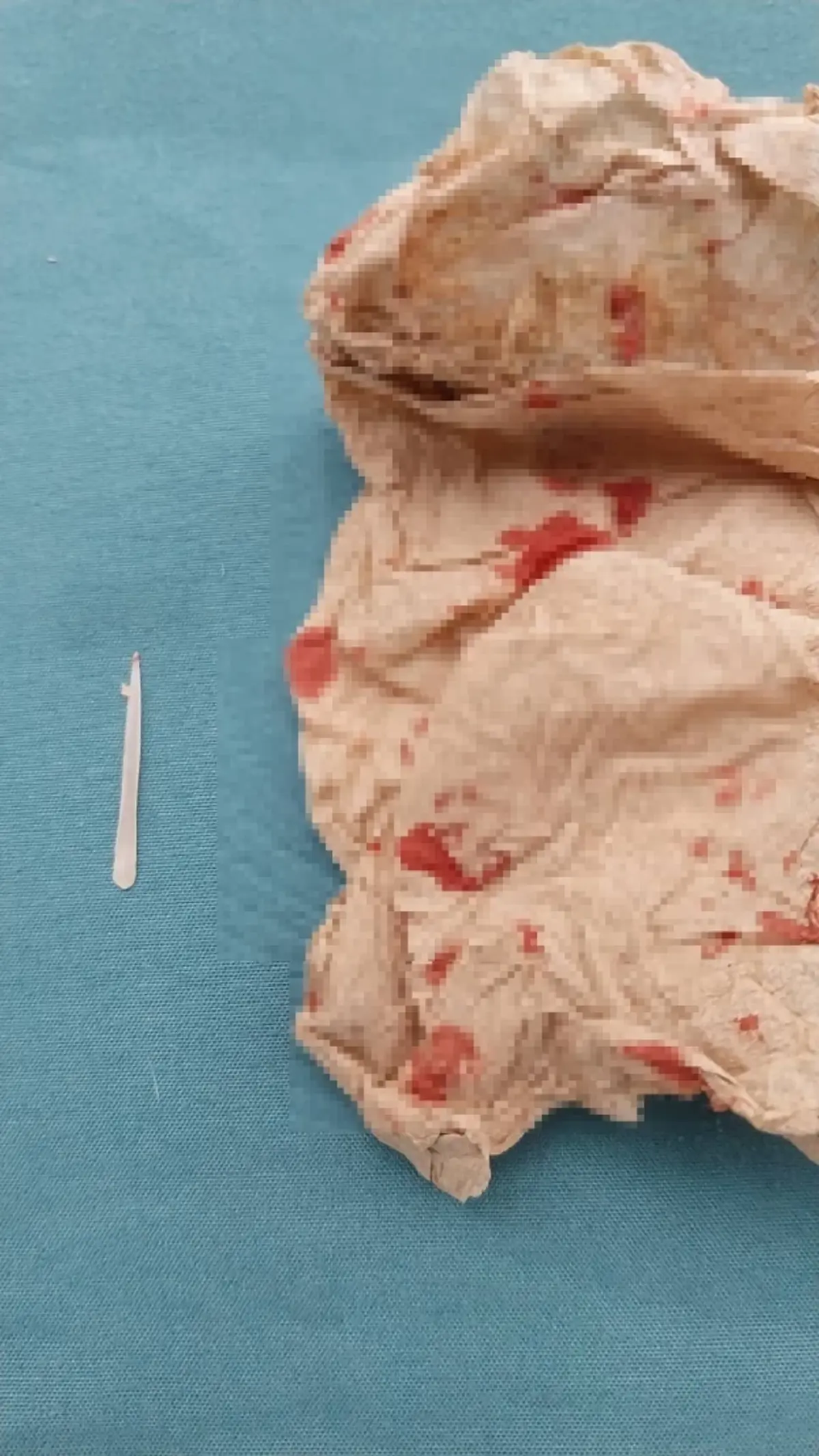 ขนลุก "ก้างปลาติดคอ" อยู่ๆ โผล่ทะลุหลังหู เพจดังเตือนอันตรายมาก