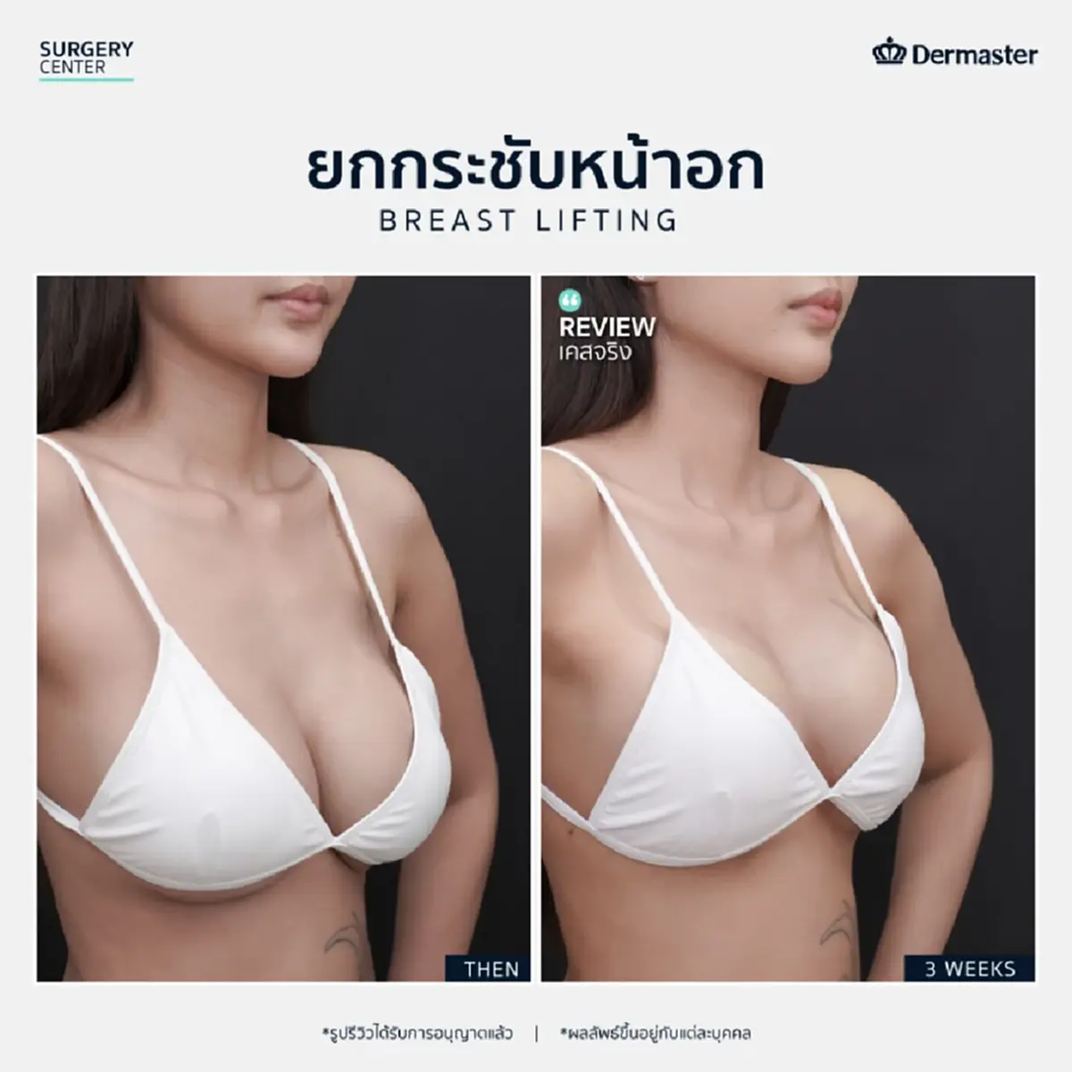 ยกกระชับหน้าอก