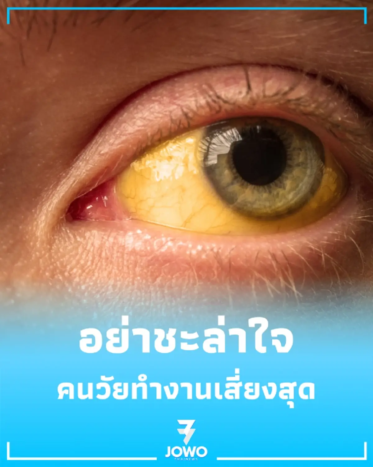 แค่กินร่วมกันก็ติด ยอดปี 69 พุ่ง 651 ราย วัยทำงานเสี่ยงสุด