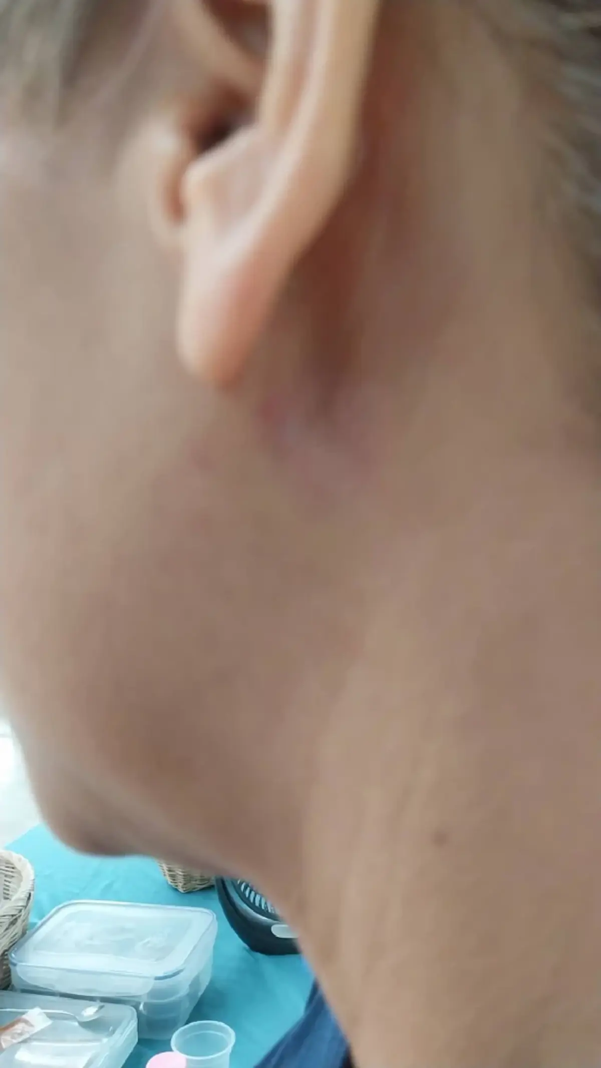 ขนลุก "ก้างปลาติดคอ" อยู่ๆ โผล่ทะลุหลังหู เพจดังเตือนอันตรายมาก