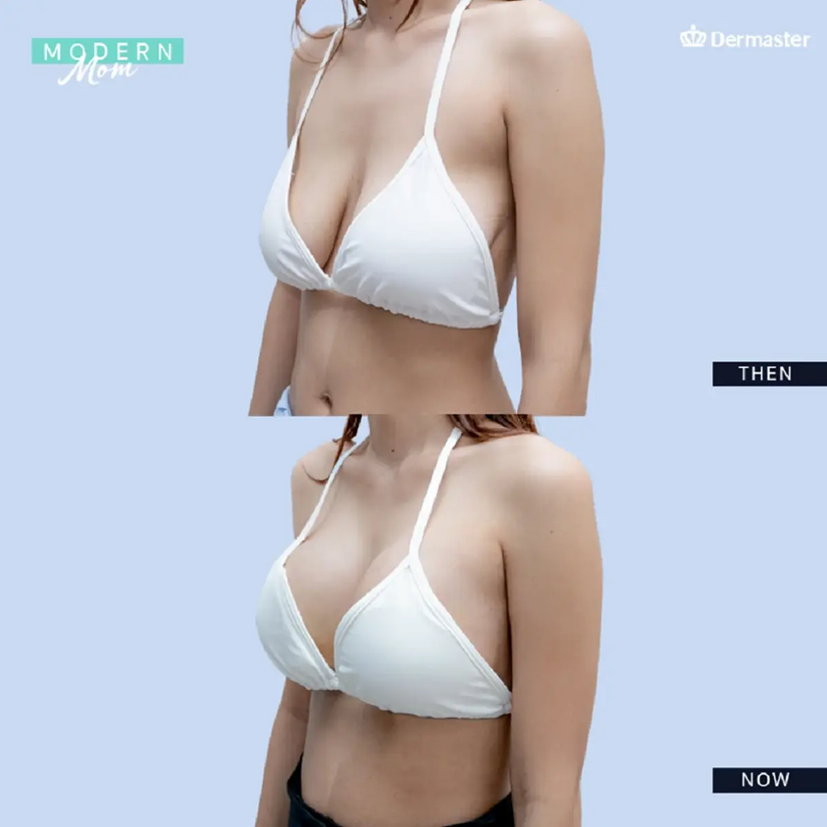 เทคนิคยกกระชับหน้าอก