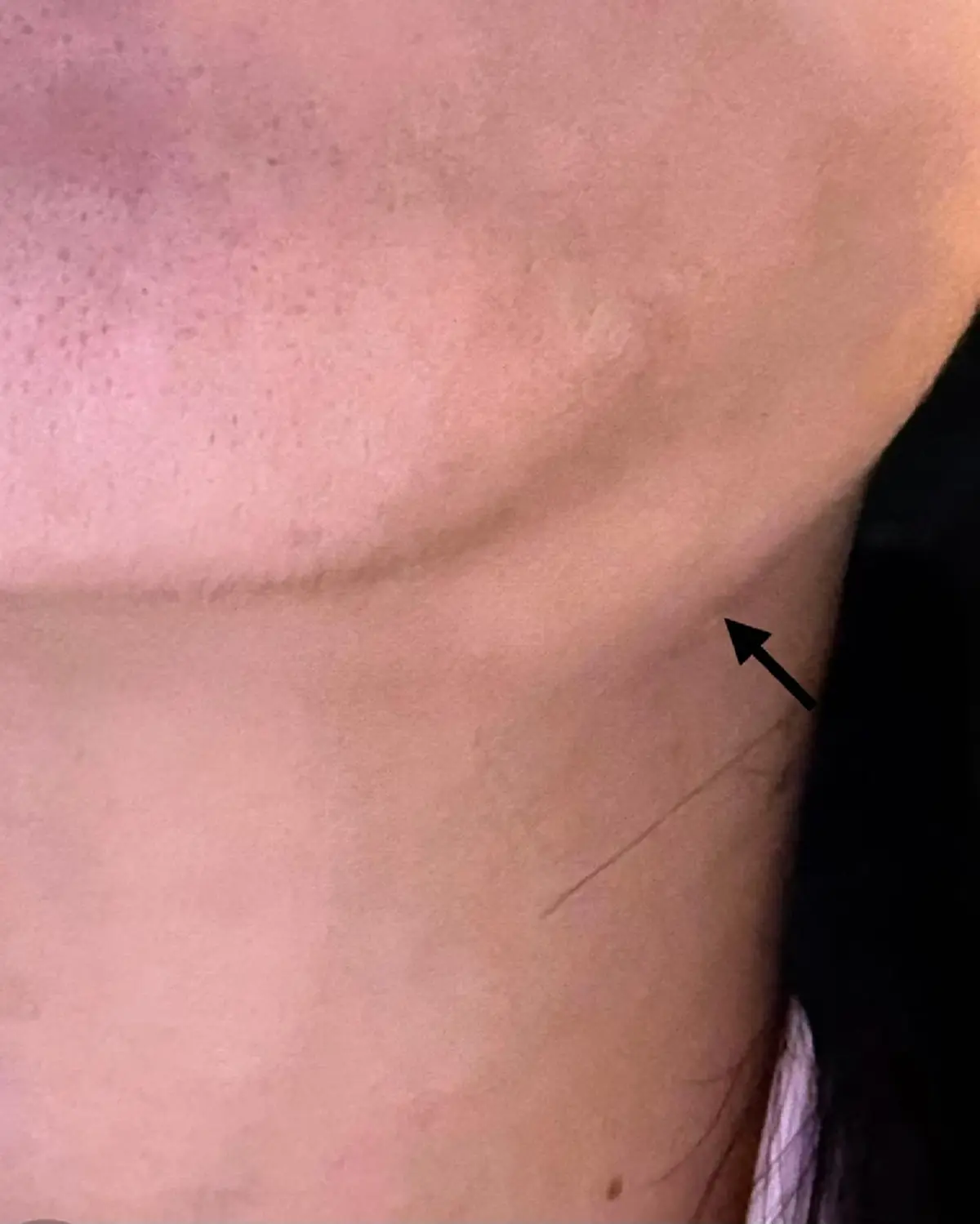 "หญิง31" พบต่อมน้ำเหลืองโต มา 3 เดือน สุดท้าย เจอเต็ม ๆ เป็นโรคหายาก