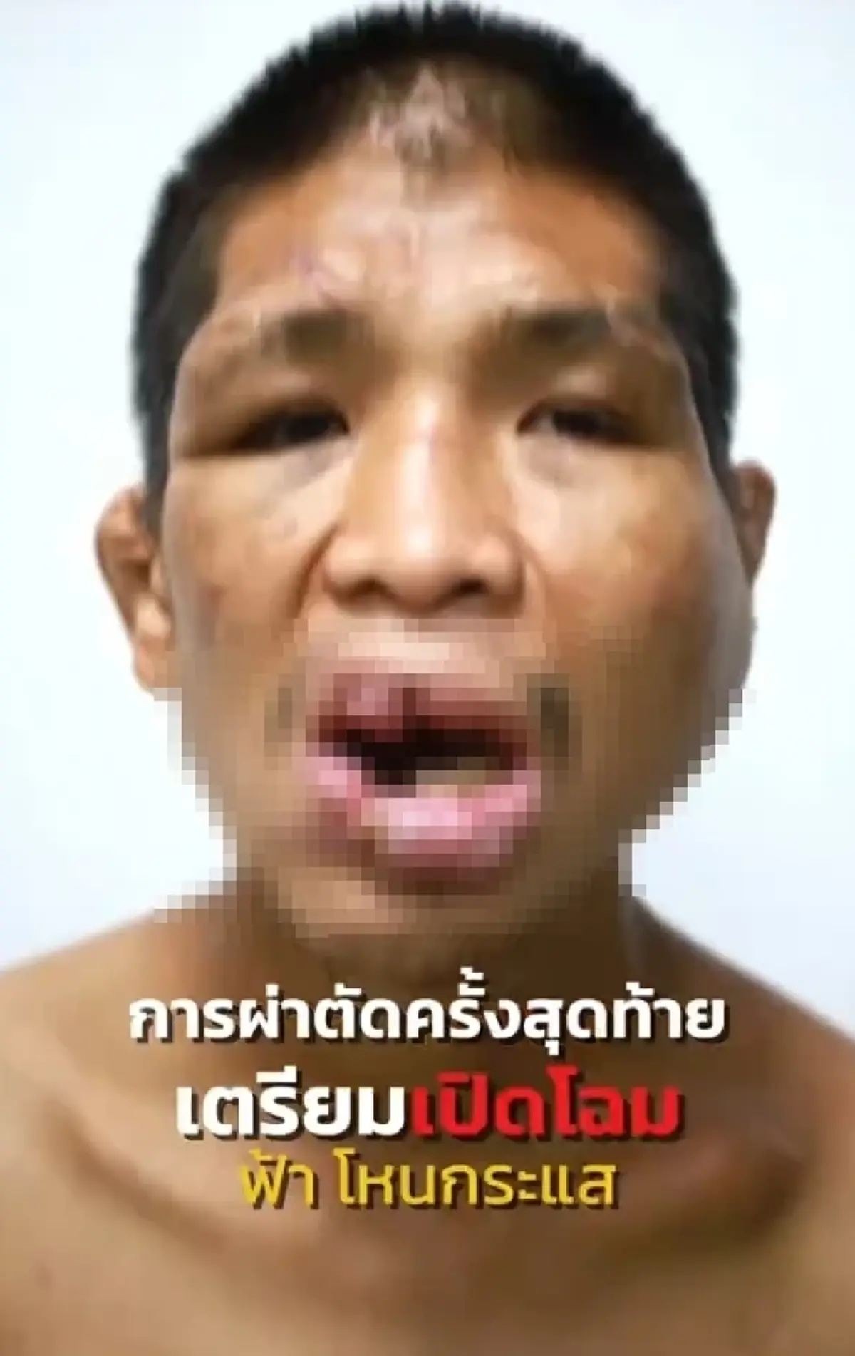 จำแทบไม่ได้ "น้องฟ้า โหนกระแส" ศัลยกรรม 4 ปี เหมือนได้เกิดใหม่