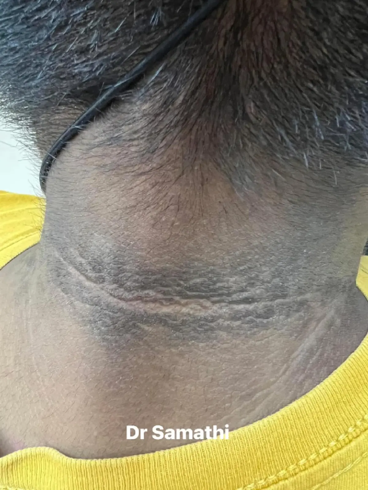 เปิดความจริง คอคาร์บอน แท้จริงคือสัญญาณอันตราย ต้องแก้ให้ตรงจุด