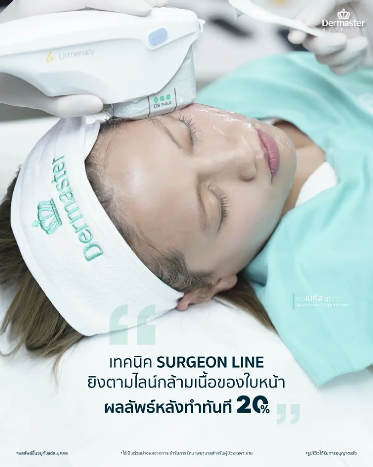 Ulthera Prime ยิงกี่ช็อต