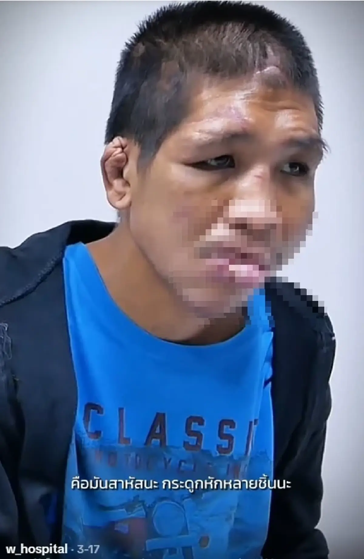 จำแทบไม่ได้ "น้องฟ้า โหนกระแส" ศัลยกรรม 4 ปี เหมือนได้เกิดใหม่