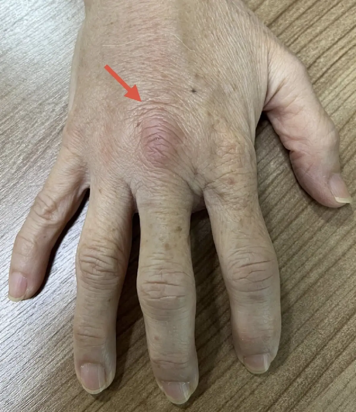 นั่นไง "หญิงอายุ 62" โดนหนามกุหลาบตำ สุดท้าย ไปตรวจ เจอจังๆ 