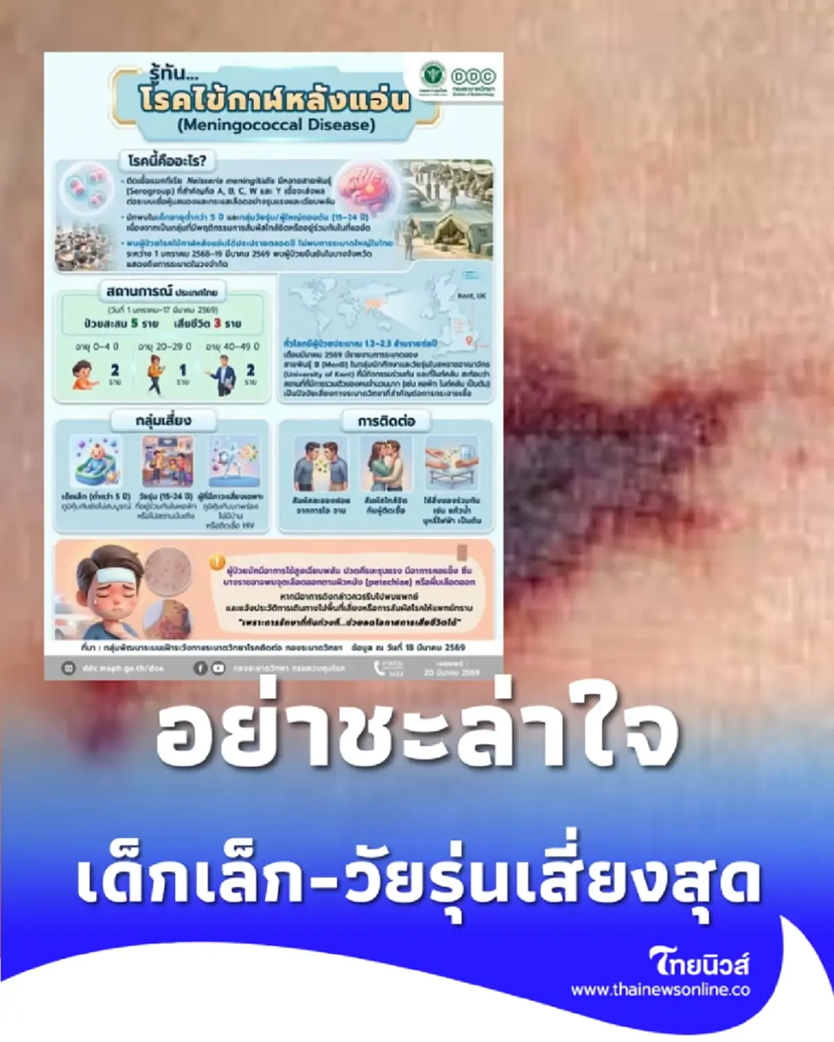 อย่าชะล่าใจ ไข้กาฬหลังแอ่นไทยพุ่งสูงสุดใน 10 ปี เด็กเล็ก-วัยรุ่นเสี่ยงสุด