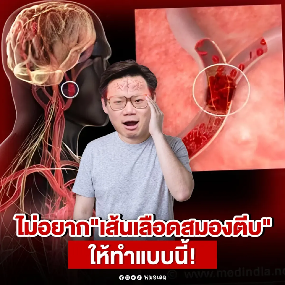 ไม่อยากเป็น “เส้นเลือดสมองตีบ” ทำตาม 5 ข้อดังนี้เลย หมอเจด เผยเอง 